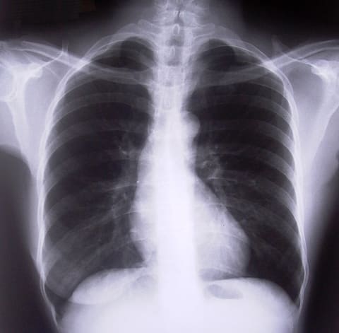 chest-xray-1526779