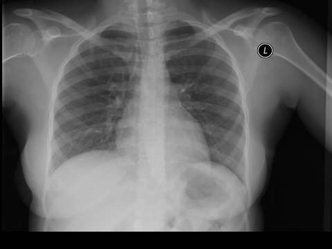 chest xray 2