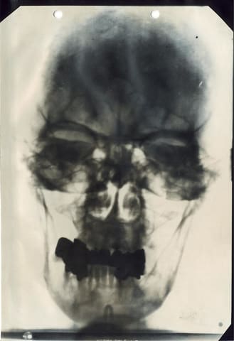 X-ray of Hitler's head